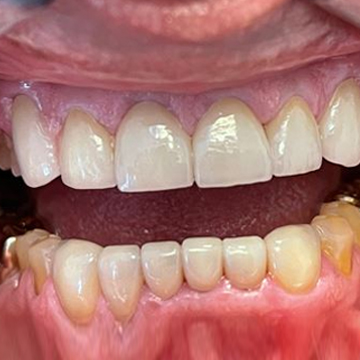Crown For Worn Out Dentition - After