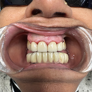 Anterior Crowns - After