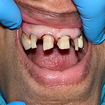 Anterior Crowns - Before