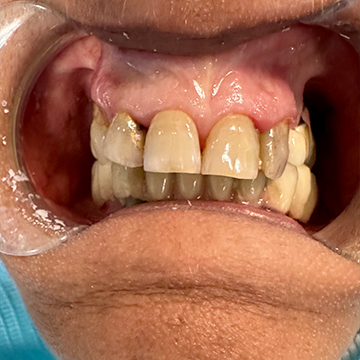 Anterior Crowns - Before