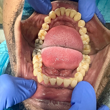 Deep Cleanings - After