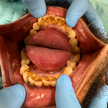 Deep Cleanings - Before