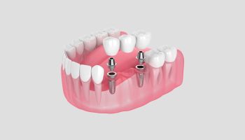 What to Expect From Dental Implant Care